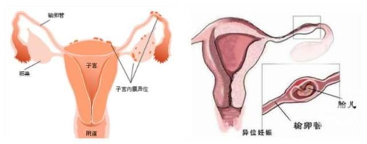 宫内早孕6周未见胚芽