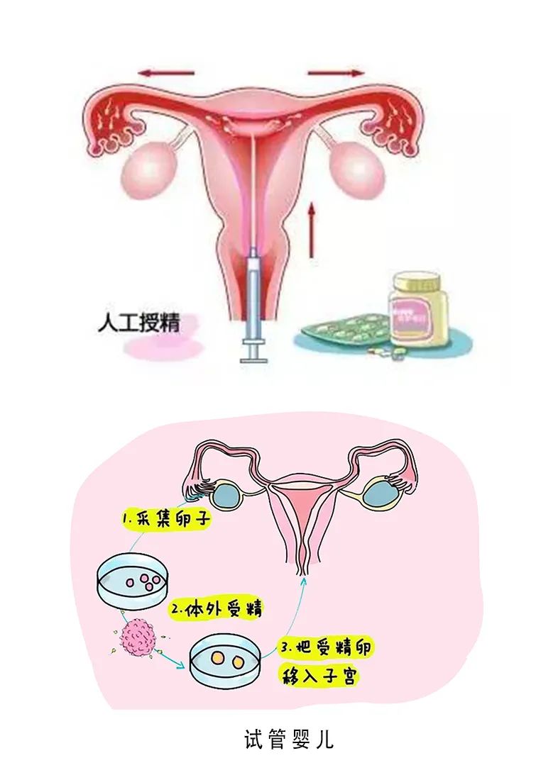 宫内早孕
