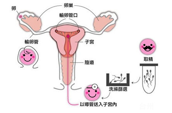 宫内早孕