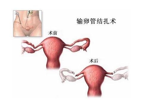 宫内妊娠
